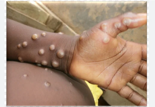 Monkeypox Death Rate 